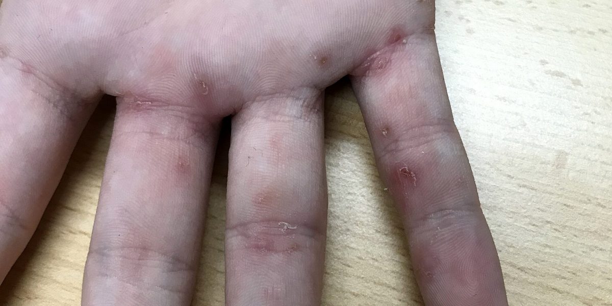 Skin infection outbreaks — scabies