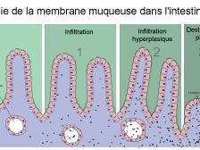 Coeliac disease treatment — coeliac disease