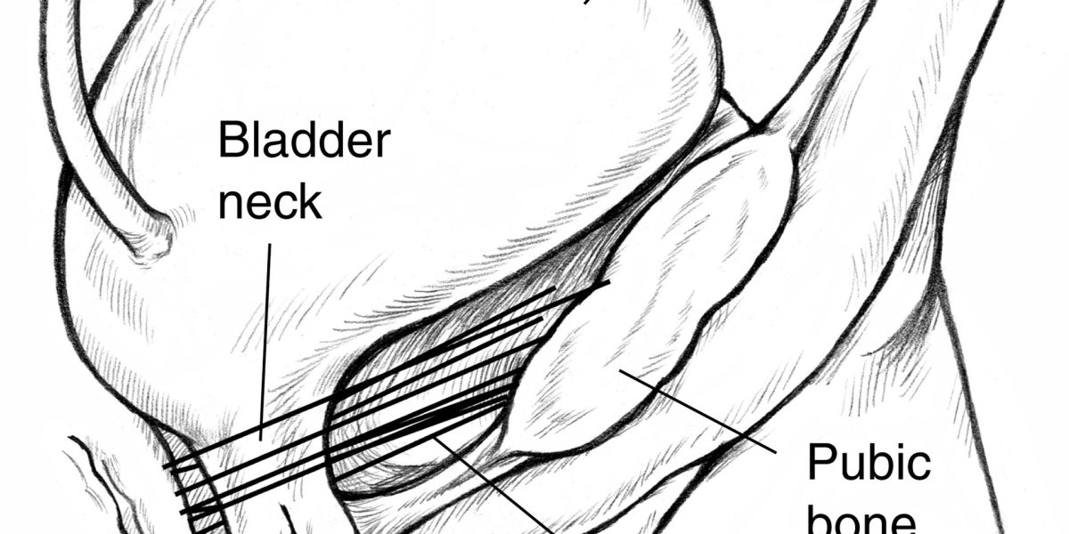 Incontinence care — incontinence